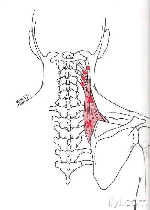 不可过度紧张的肌肉(2)斜角肌