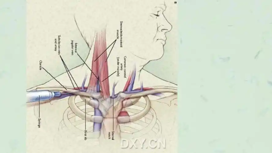 锁骨下静脉穿刺图课件