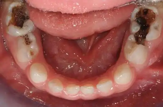 通过这些年的科普工作,"少吃糖,吃糖会蛀牙"几乎成了妇孺皆知的共识.