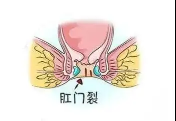 肛裂难以自愈,武汉博仕肛肠医院:久拖不治易形成陈旧性肛裂!