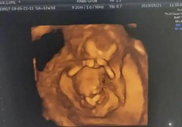 胎儿颈项透明层简称nt,指胎儿颈后部皮下组织内液体积聚的厚度,目的是