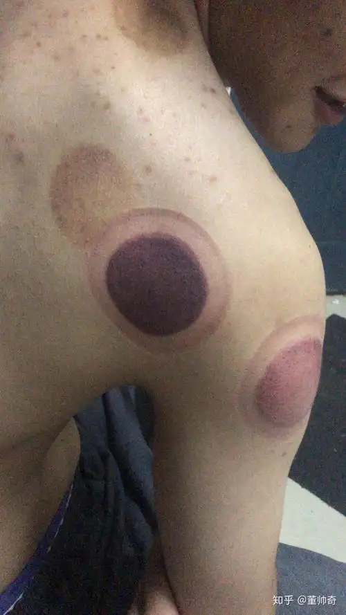 蟹邀,我也喜欢拔罐,身为体育人,身上多多少少有点伤,拔罐感觉还挺爽的