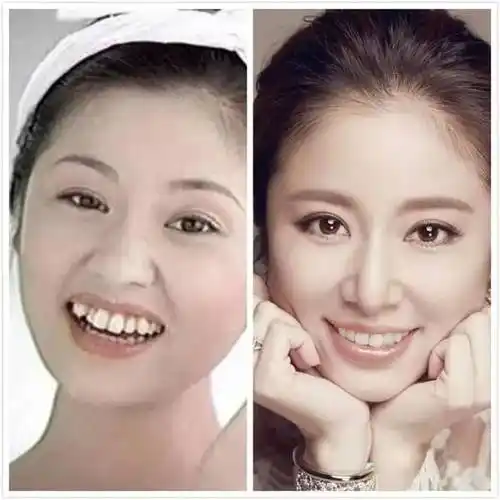 明星整牙的惨痛经历告诉你,美是要付出代价的!