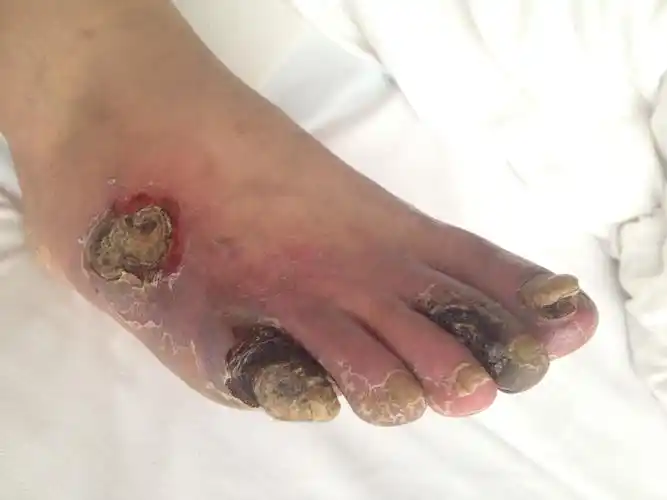 一例重症脉管炎患者的治疗前后对比证据