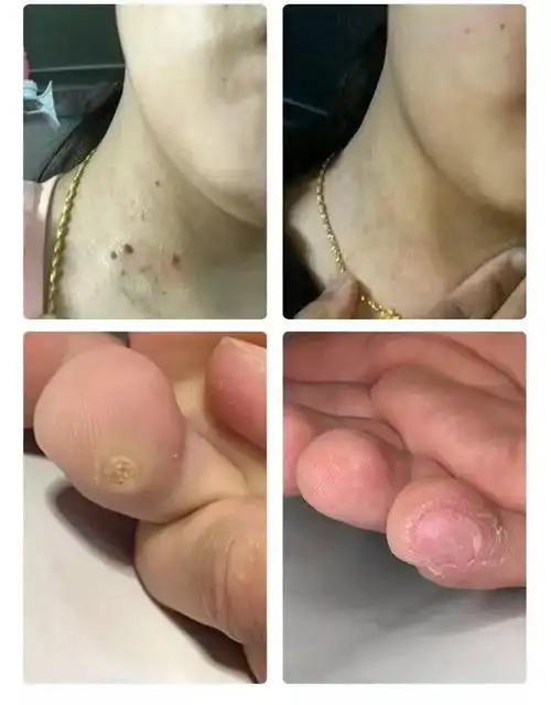 5%米奎莫克尤膏丝状疣脖子 颈部丝状疣去除器扁平疣尖锐疣外用手足