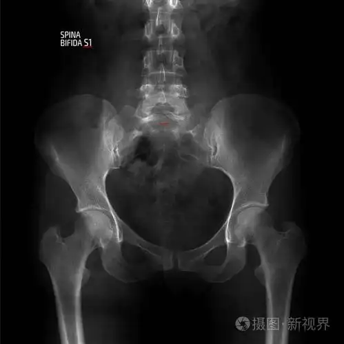 脊柱裂s1. 标记.