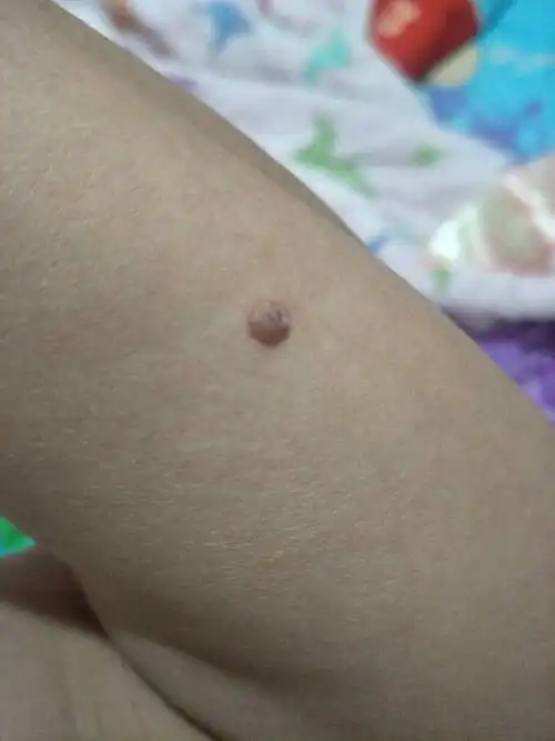 手臂上长了个硬疙瘩,这是什么?