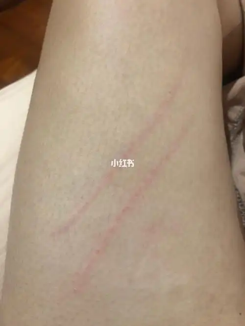 被自己的狗狗不小心抓伤了,没有出血,但是有一点点破皮了.