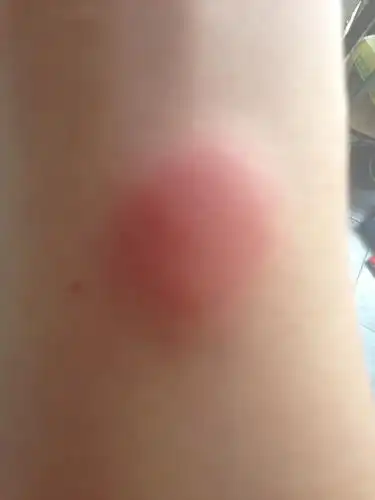 ppd试验第二天肿起来了,正常吗?是以前打过结核疫苗吗