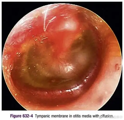 中耳炎一定需要抗生素么