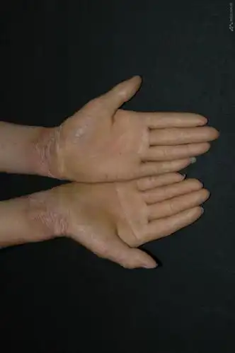 表皮松解性角化过度症严重掌跖角化过度1型1例