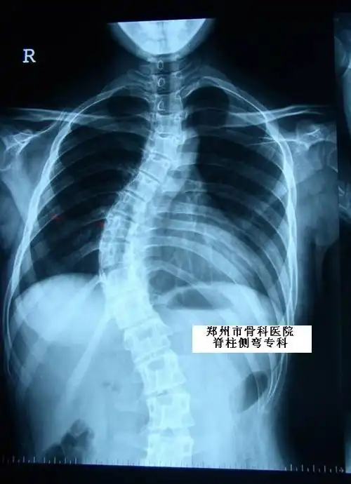 凸侧加压,同时去旋转的原则矫正脊柱的冠状面,矢状面及轴面的三维畸形