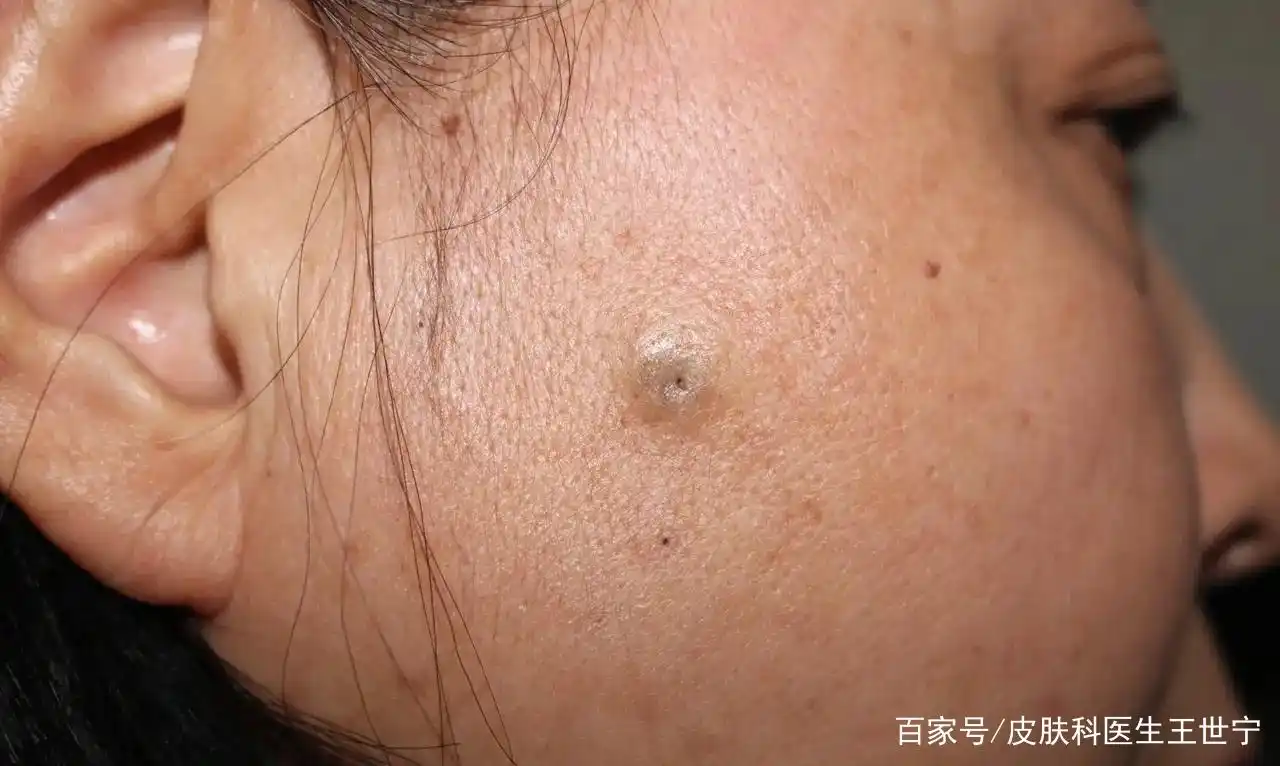 脸上长了一个小囊肿!
