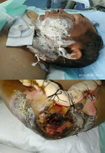 电击伤的临床治疗与康复