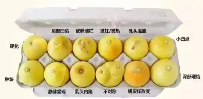 乳头突然凹陷  乳头四周疼痛,瘙痒或出现鳞片状斑点  乳腺大小和形状