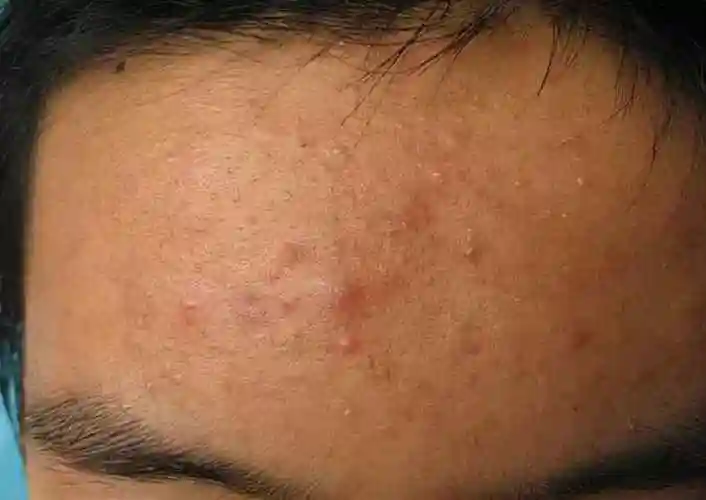 五:额头长痘-心火旺盛额头上长痘,一般是心火旺盛所致,此类患者应养成