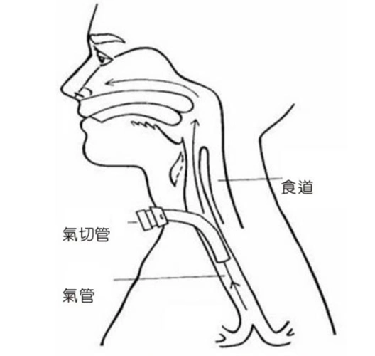 气管切开术是救命的手术吗?