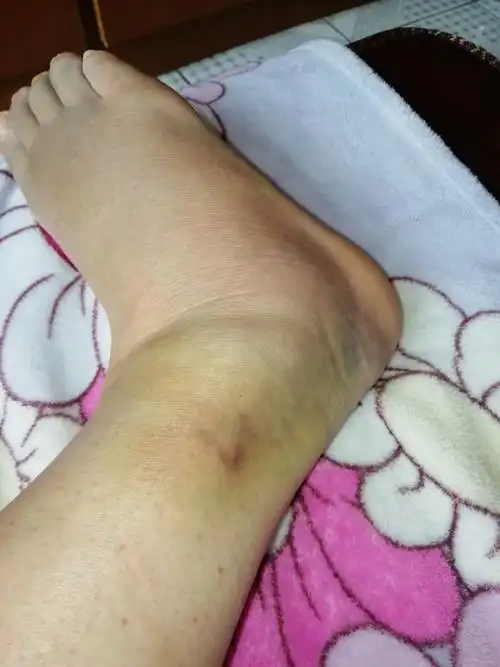 第6天.皮肤各处都裱出淤青来了.