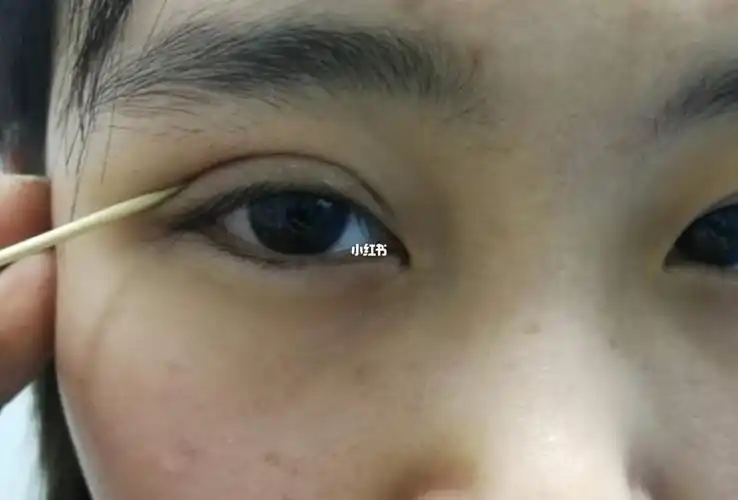 感觉埋线眼睛不够吸粉,夺眶欲出是什么感觉_双眼皮_双眼皮修复_美妆
