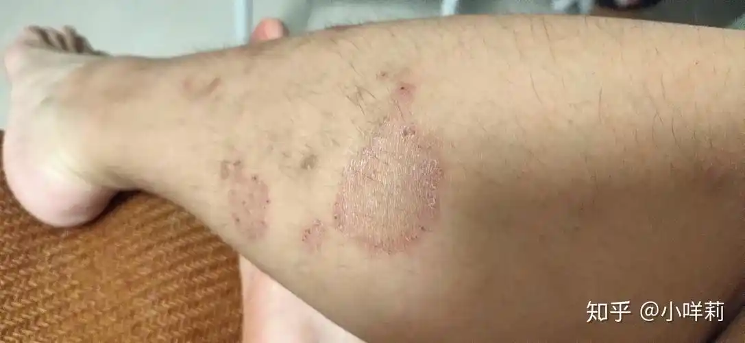 人得了猫癣怎么治疗啊急