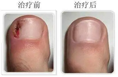 广州市胸科医院 程锋刚 文章列表 >甲沟炎,一定要拔甲吗?no!