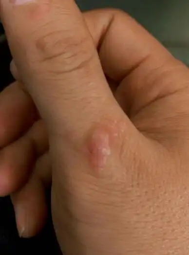 这个刺瘊治了几次,怎么越治越大,我该怎么办?几次都是冷冻的,用液氮!