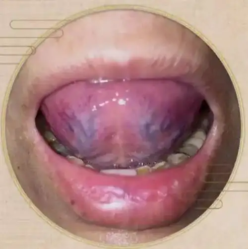 舌头:舌下出现血管粗大,血管分叉,颜色暗紫的状态时,可能是血瘀体质.