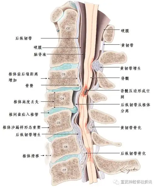 神外科普|颈"椎"病,颈"髓"病,一字之差,意义大不同
