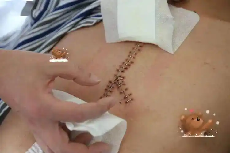 医疗技术小伙被刀刺中心脏医生紧急抢救从死亡线拉回