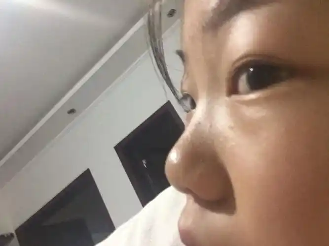 我的山根和鼻梁是不是很低,能改善吗
