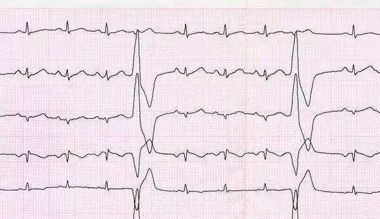 什么是室性早搏?我的室早需要治疗吗?3招帮你判断好!