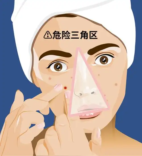 危险三角区就是鼻根和两个嘴角之间形成的三角形区域.