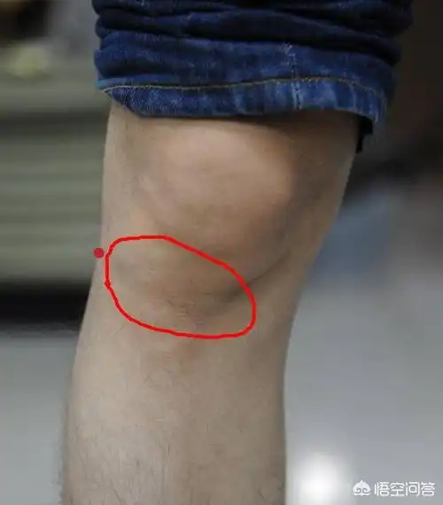 滑膜炎会引起膝关节内的少量积液.