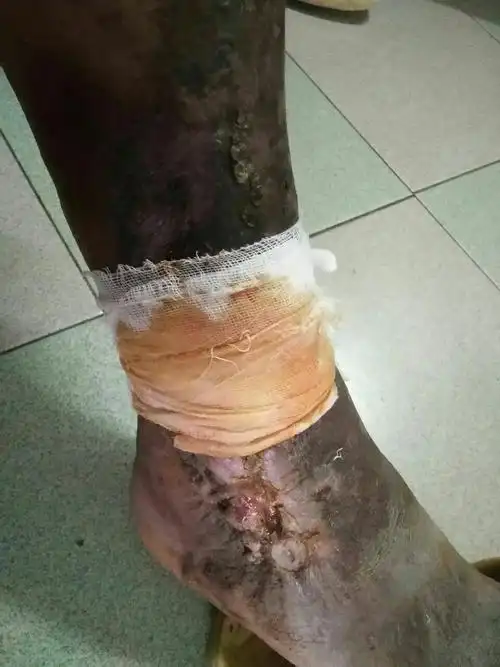 糖尿病皮肤溃烂