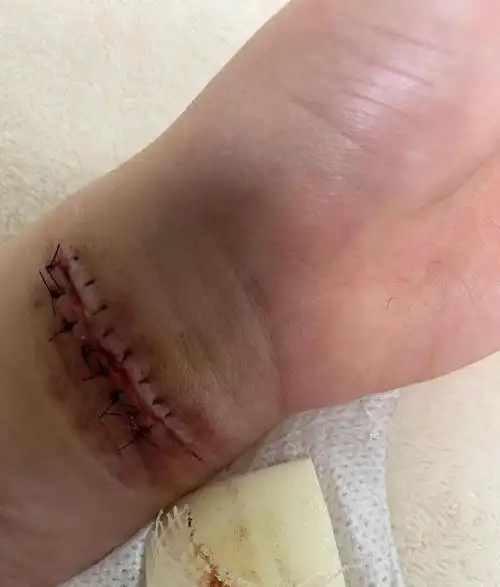 aoa权珉娥再次割腕自杀 神经线断了不打麻药缝合|缝针_网易订阅