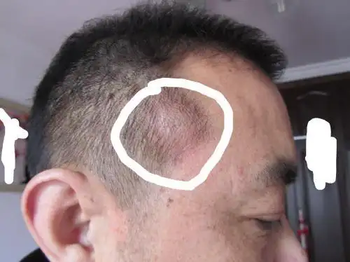 谁知道我爸爸头上这个包是什么