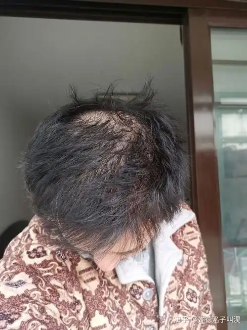 大三的一个男生,21岁,头顶漩涡处头发少得可怜,以前头发很茂密,晚上