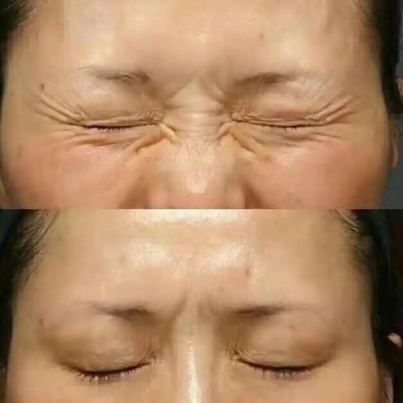 盘点女明星偏爱的热门医美项目,看看她们是如何悄悄变美的