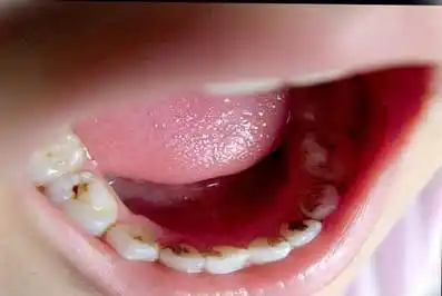 出现问题常常得不到重视,尤其是孩子的乳牙,许多人会认为反正要换牙