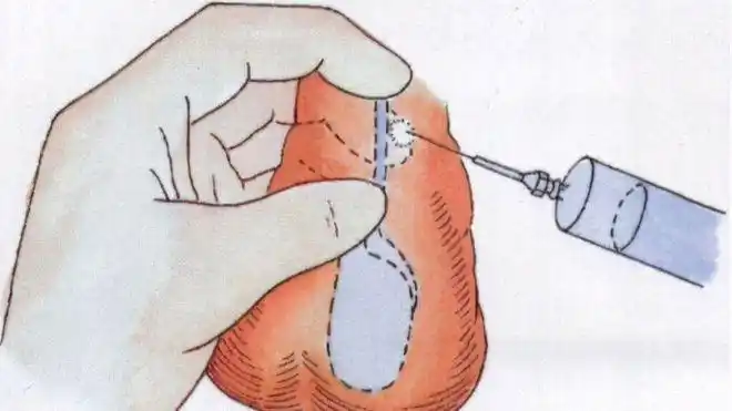 会不会影响性功能?