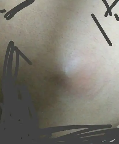 屁股长了个比鸡蛋小的硬块,大约二年了.