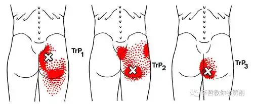 激痛点与传导区臀大肌功能视频详解协助外展协助歼关节外旋协助维持