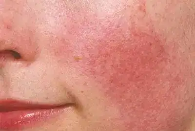 敏感肌修复最全指南大概就在这里了 | 护肤研究所