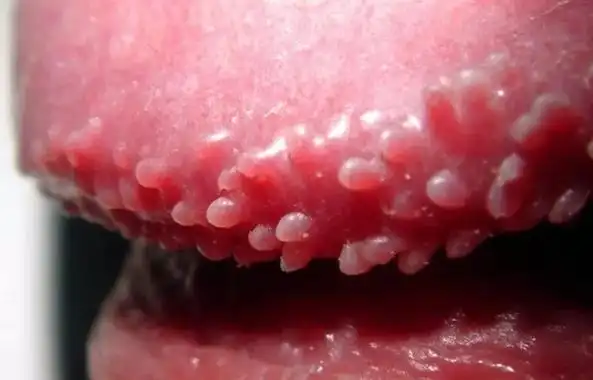 (尖锐湿疣患者冠状沟丘疹)5,生殖器疱疹不少人都有过因上火嘴上起水泡