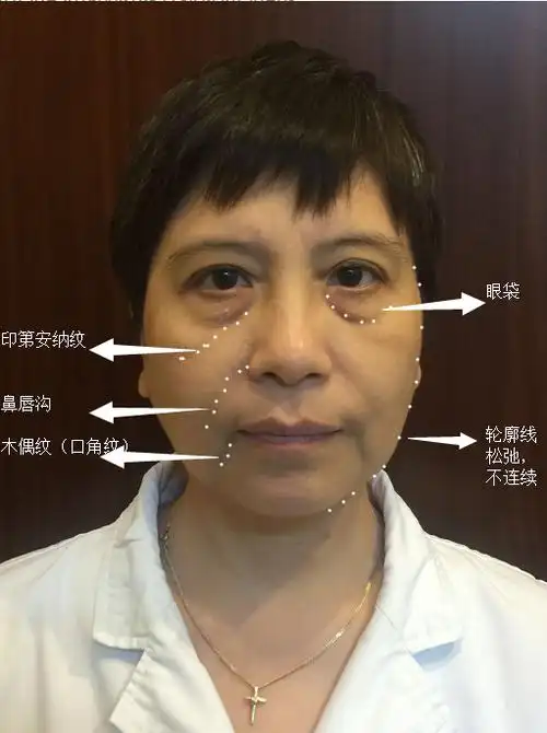 最主要的就是"三八线"开始出现,泪沟纹,法令纹,口角纹,这是让女人看