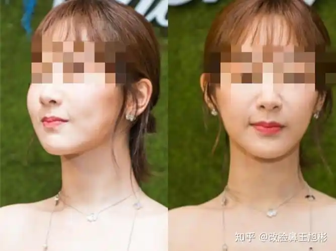 鼻基底填充后,为什么会变成"猴子"?