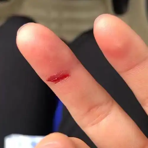 被车门夹到出血 以为我的手指已经断了 疼到飙泪 晚上睡觉疼的感觉