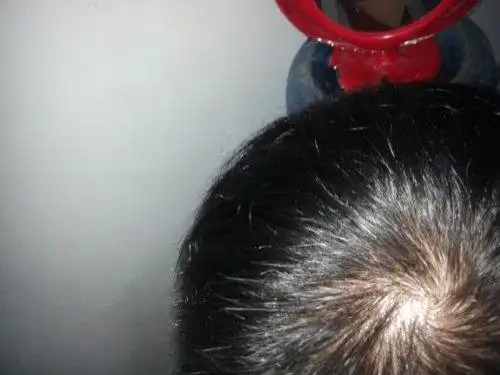 这是我头上漩涡处的照片,感觉头发比较少,你们是这样的吗?