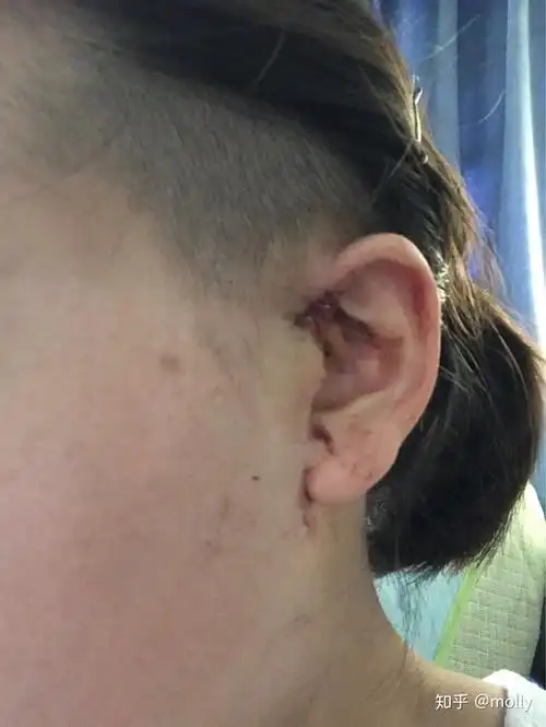 生孩子后耳瘘发炎做引流痛惨了