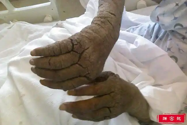 仅仅是"疥疮"这个词听起来就很不舒服,疥疮是由皮肤下面的微小寄生螨